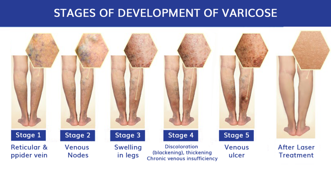 Varicose Veins Treatment - Chirayu Healthcare Polyclinic & Diagnostics