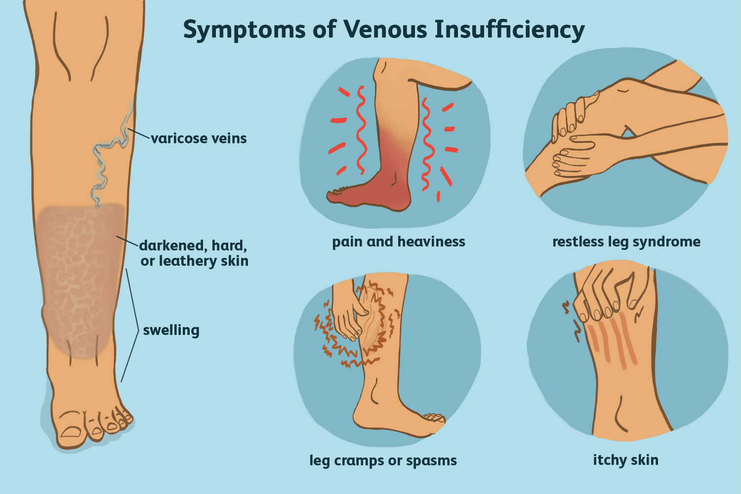 Varicose Veins Treatment Chirayu Healthcare Polyclinic Diagnostics